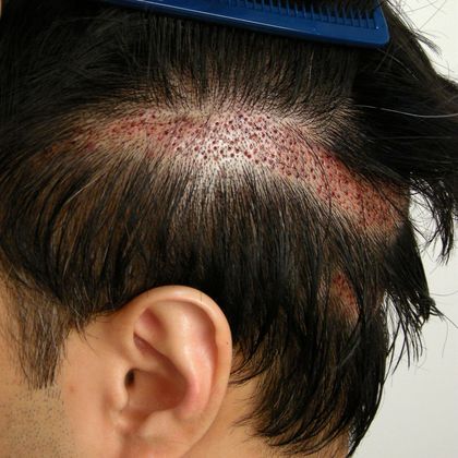 Donor Area After Hair Transplant Photos: FUE -  Post-op zone shave FUE