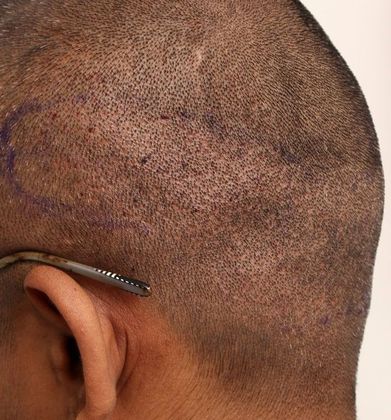 Donor Area After Hair Transplant Photos: FUE - Immediately post-op FUE