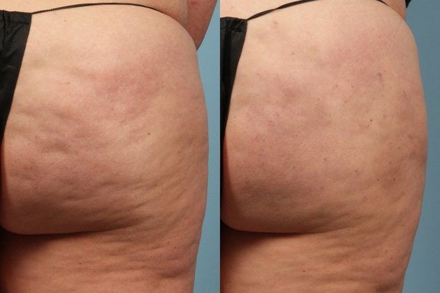 Cellfina Cellulite Treatment: Cost, Reviews, Treatment