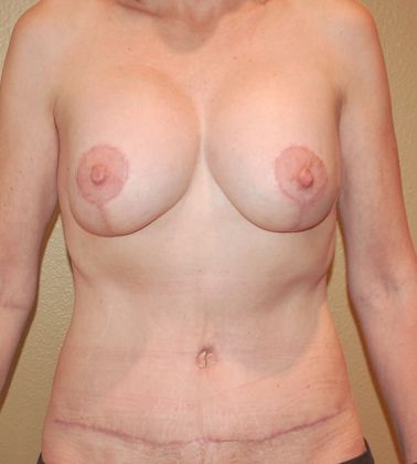 Mommy Makeover Case 58 - After