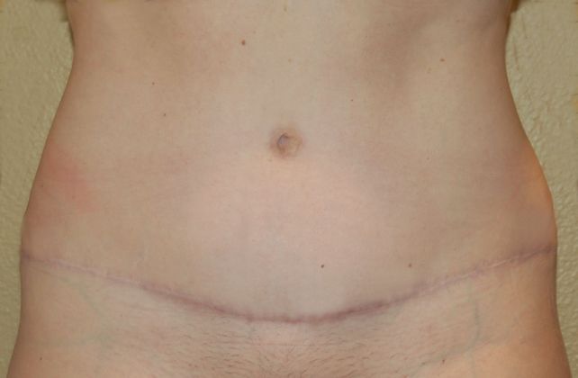 Mommy Makeover: Case 59 - After