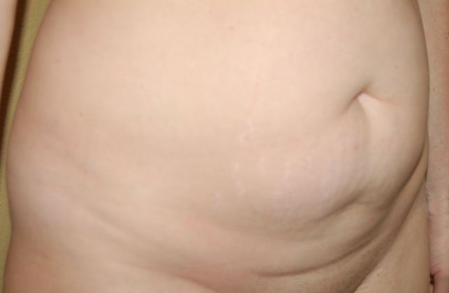 Mommy Makeover: Case 59 - Before