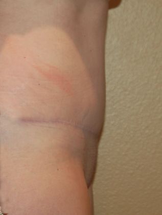 Mommy Makeover: Case 59 - After