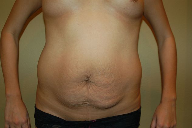 Mommy Makeover: Case 60 - Before