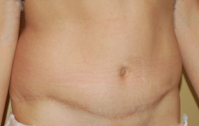 Mommy Makeover: Case 60 - After