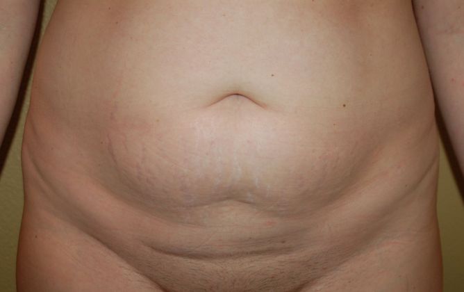 Tummy Tuck (Abdominoplasty) Case 63 - Before