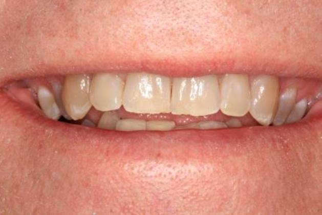 Kor Whitening: Case 1 - Before