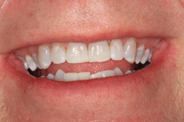 Kor Whitening: Case 1 - after