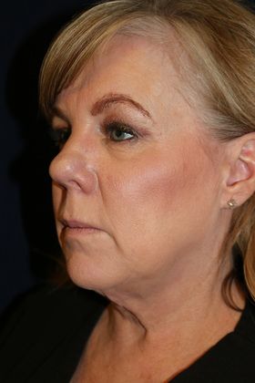 After Kybella® treatment