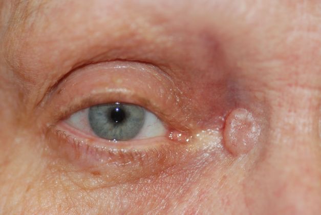 Facial Tumors and Growths Case 1 - Before