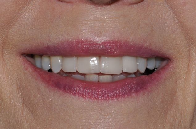 Porcelain Veneers Jessica Veneers - After