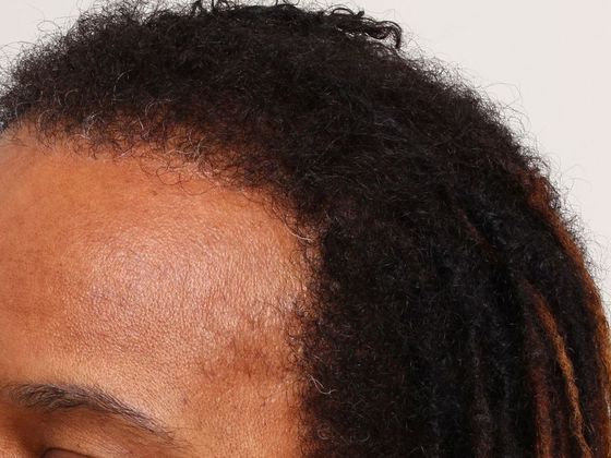 Hair Transplant - Female Hairline FUT (2) - After