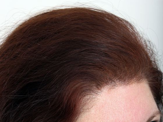 Hair Transplant - Female: Frontal FUT - After female hair transplant