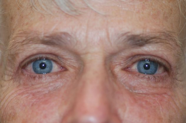 Upper Eyelid Blepharoplasty Case 45 - After
