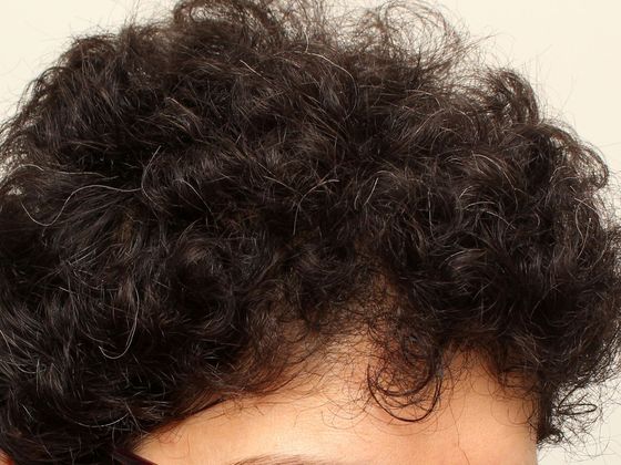 Hair Transplant - Female: Frontal FUT (2) - After female hair transplant