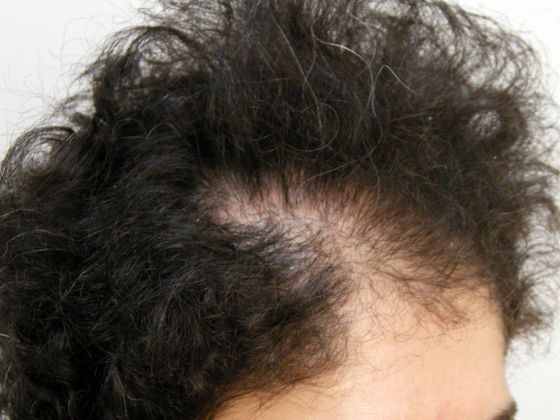Hair Transplant - Female: Frontal FUT (2) - Before female hair transplant