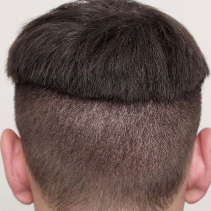 Hair Transplant - Donor Area Afters: FUE - 10 days post-op FUE