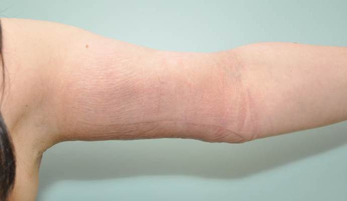 Arm Lift: Case 1 - Arm Lift, Darien - After