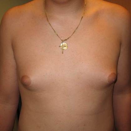 Male Breast Reduction Case 2 - Gynecomastia, Fairfield - Before