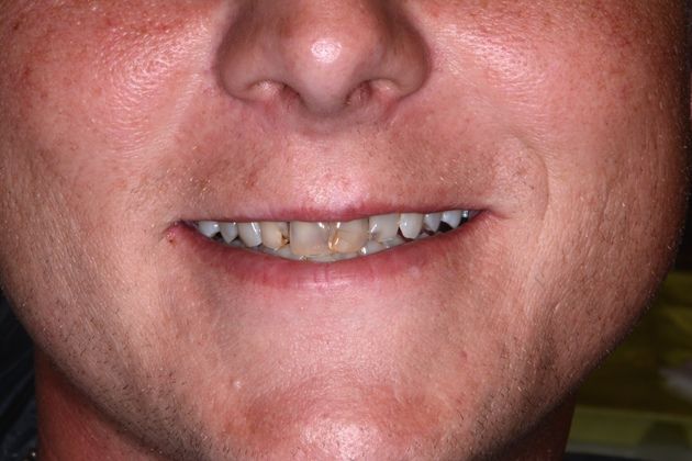 Dr. John Goodman's patient before a smile makeover