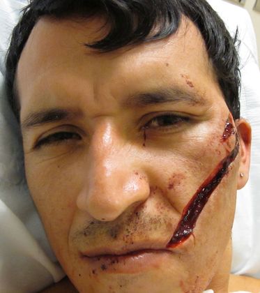 facial laceration