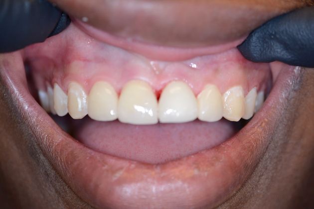 Porcelain Crowns: Zion