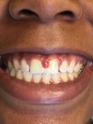 Laser Gum Treatment Patient #1 - Before