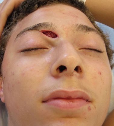 Facial Laceration Repair Case 6 - Before