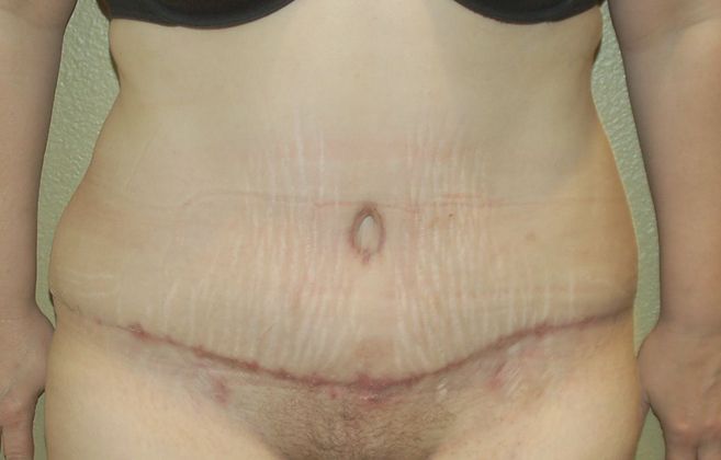 Tummy Tuck (Abdominoplasty): Case 68 - After