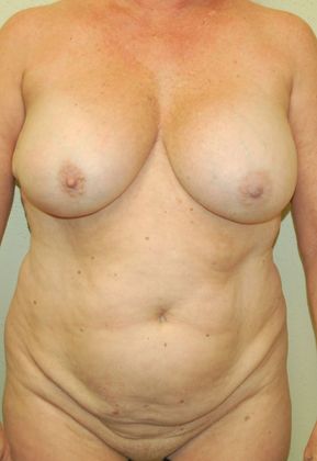 Mommy Makeover Case 62 - Before