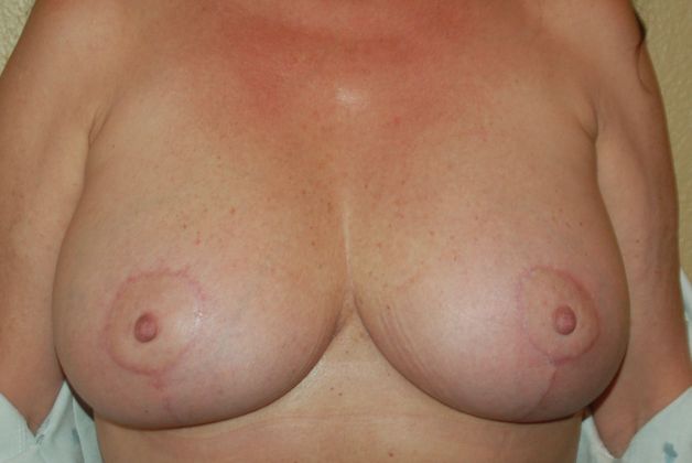 Breast Lift (Mastopexy) Case 29 - After