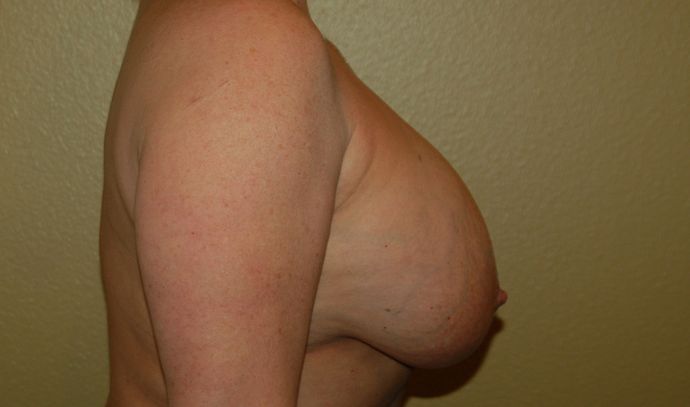 Breast Revision: Case 47 - Before