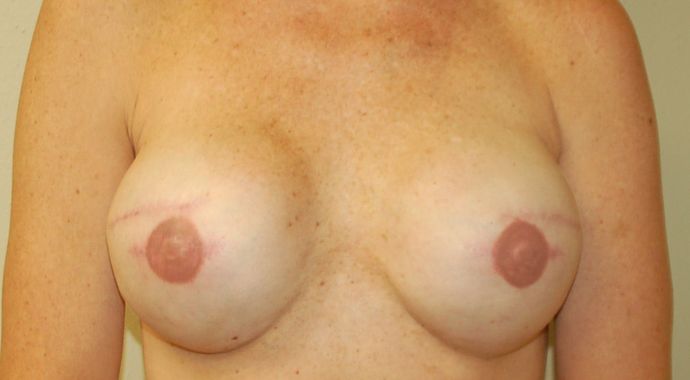 Breast Reconstruction Case 50 - After