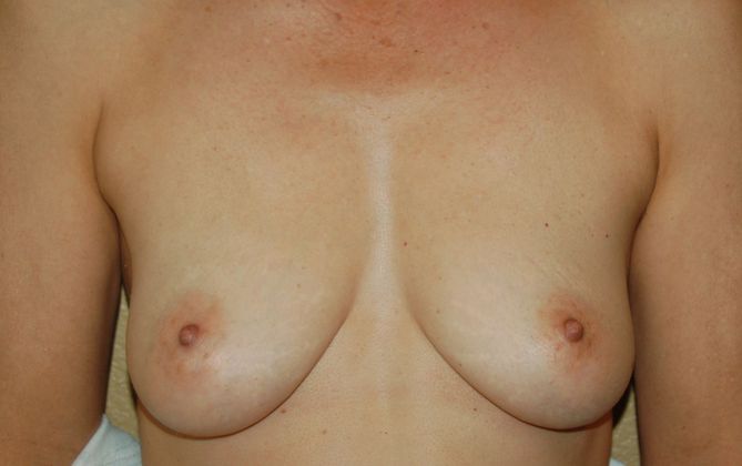 Breast Reconstruction Case 51 - Before