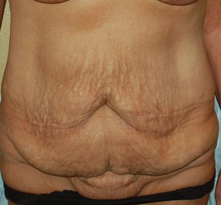 Massive Weight Loss : Case 25 - Before