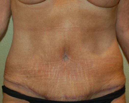 Massive Weight Loss : Case 25 - After