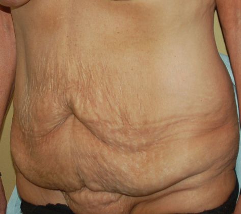 Massive Weight Loss : Case 25 - Before