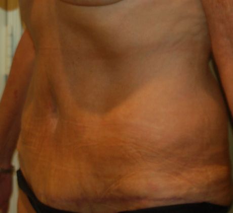 Massive Weight Loss : Case 25 - After