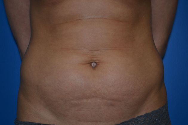 Abdominoplasty / Tummy Tuck Case 1 - Before