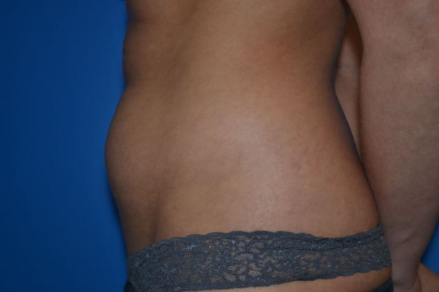 Abdominoplasty / Tummy Tuck: Case 1 - Before