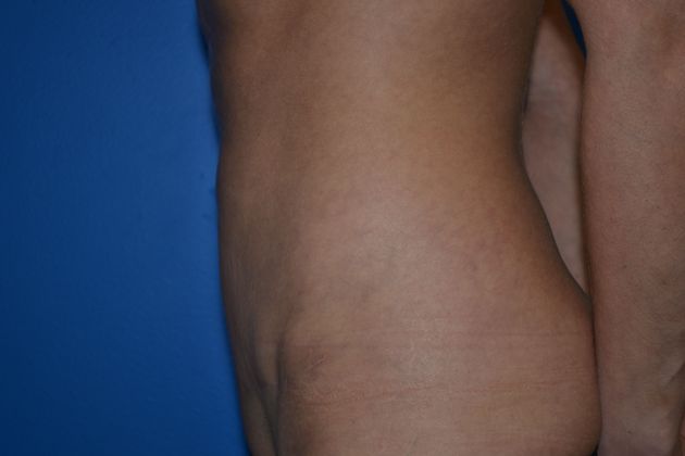 Abdominoplasty / Tummy Tuck: Case 1 - After