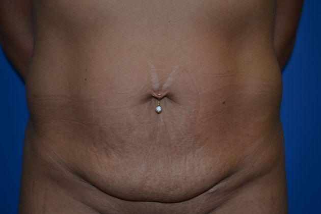 Tummy Tuck - Mini Case 1 - Before