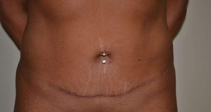 Tummy Tuck - Mini Case 1 - After