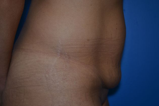 Tummy Tuck - Mini: Case 1 - Before