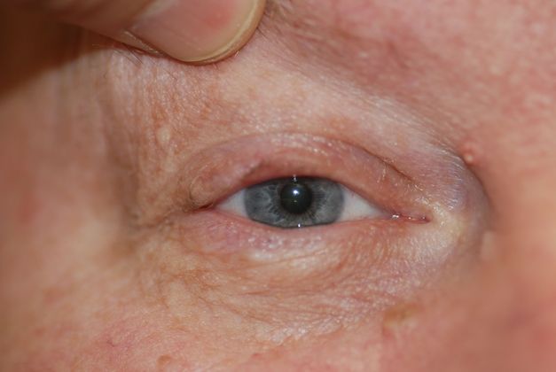 Facial Tumors and Growths Case 27 - After