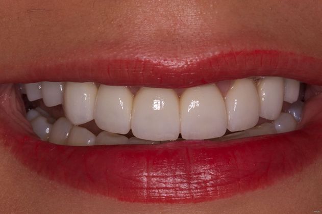 Smile Makeover Cases