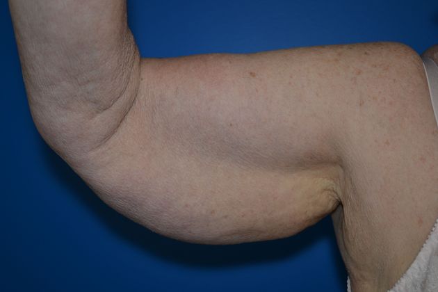 Arm Lifts Case 1 - Before