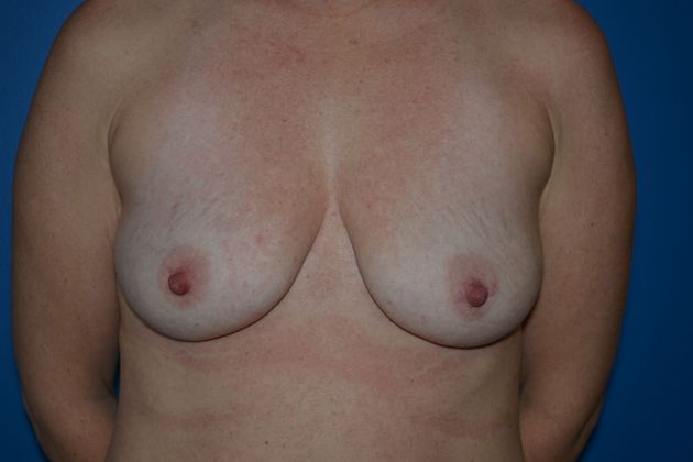 Breast Lifts Case 2 - Before