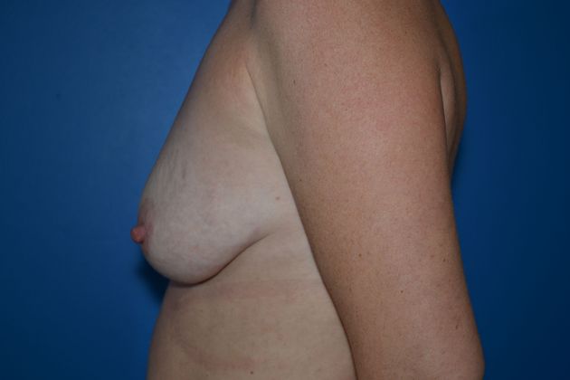 Breast Lifts: Case 2 - Before