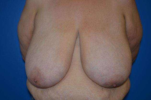 Breast Reductions: Case 1 - Before